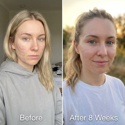 Medical Acne Scar Repair Stick™