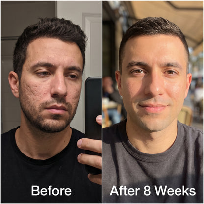 Medical Acne Scar Repair Stick™