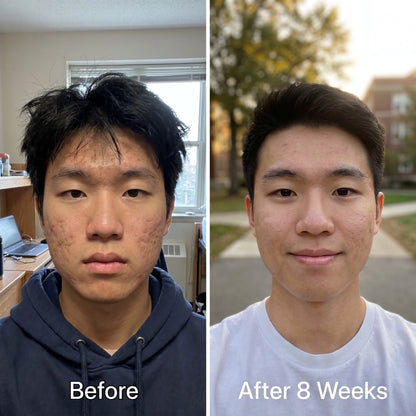 Medical Acne Scar Repair Stick™